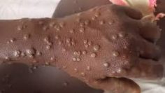 MPOX HANDS